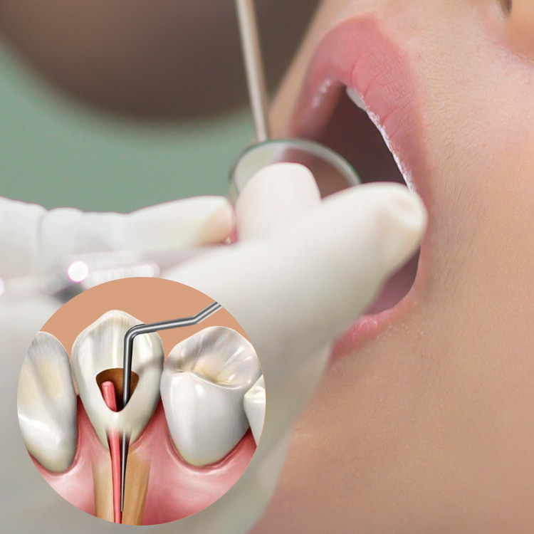 Ενδοδοντική θεραπεία ή Απονεύρωση